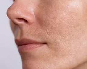 Combination Skin