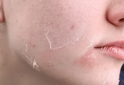 Dry / Dehydrated Skin