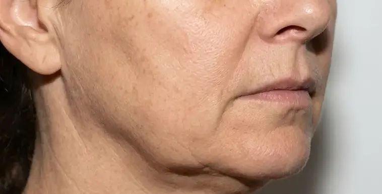 Lifting and Contour