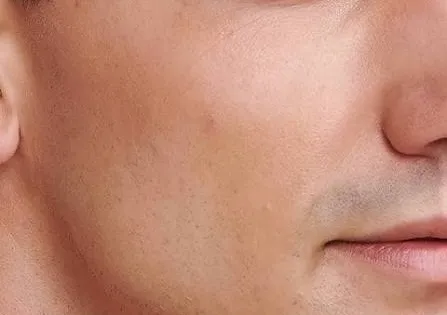 Normal Skin