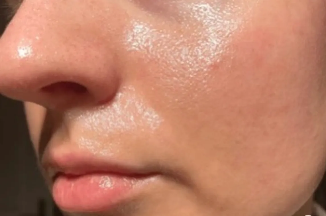 Oily / Congested Skin