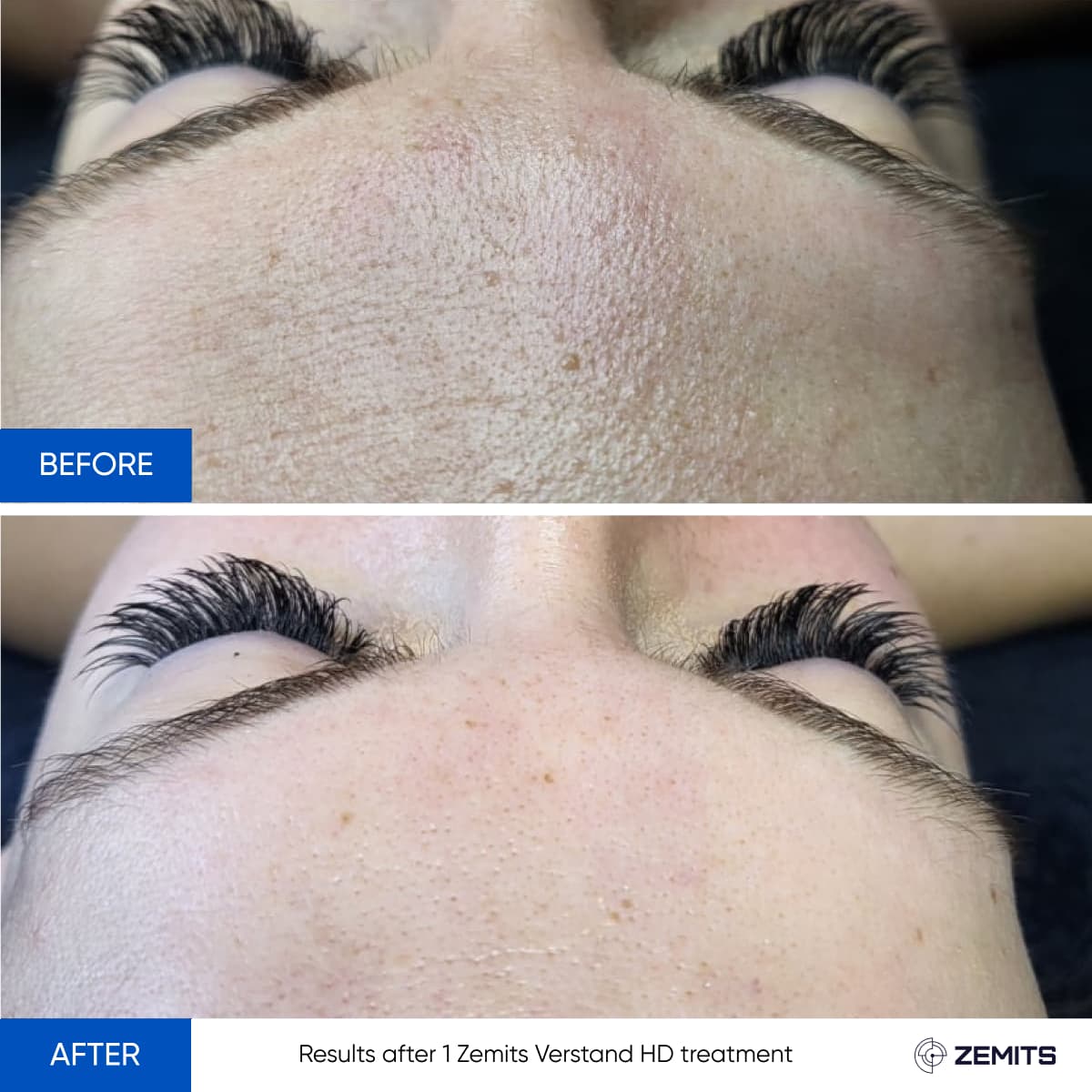 Signature Skin Treatment Results