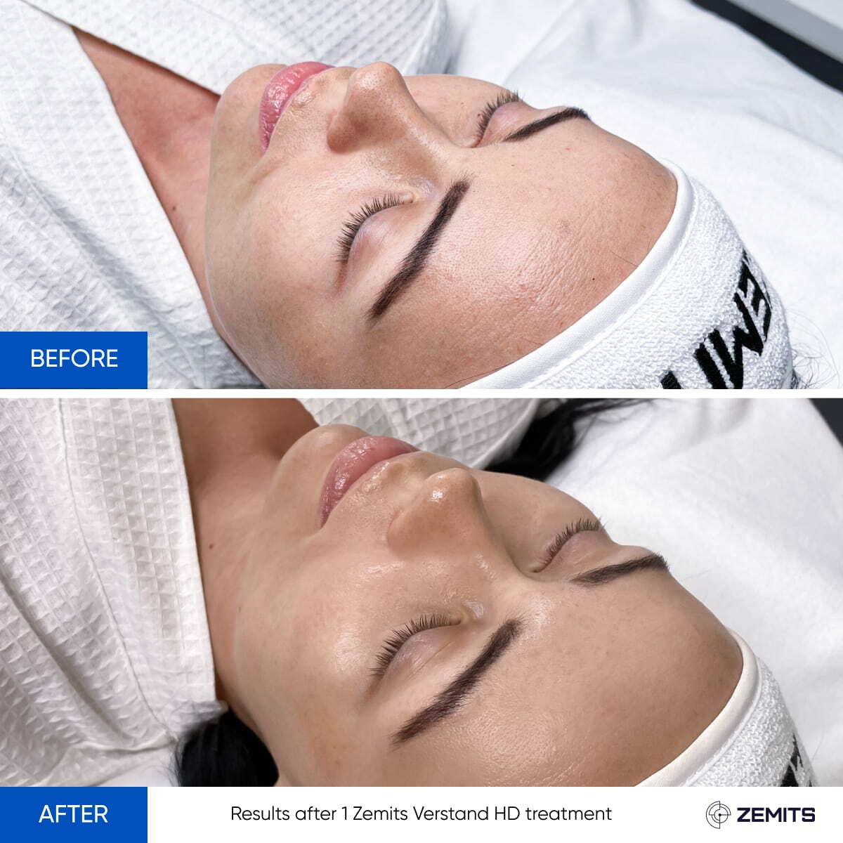 Signature Skin Treatment Results