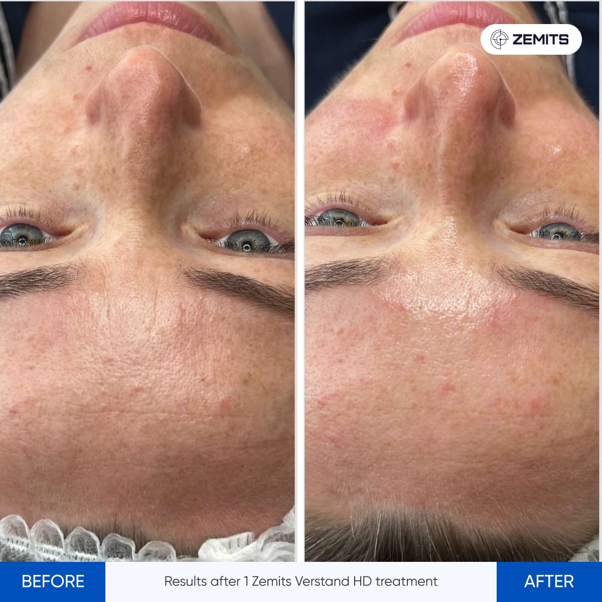 Signature Skin Treatment Results