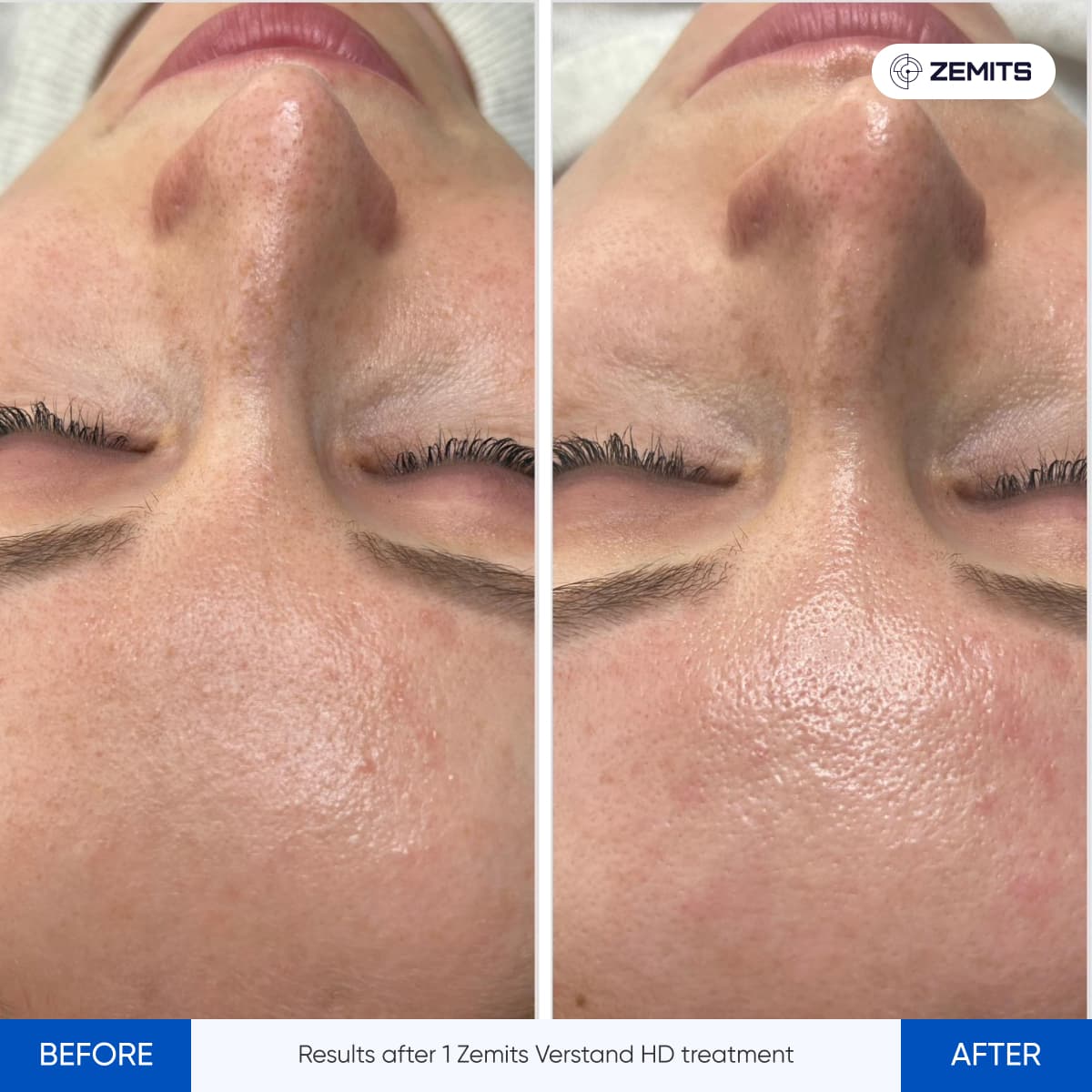 Signature Skin Treatment Results