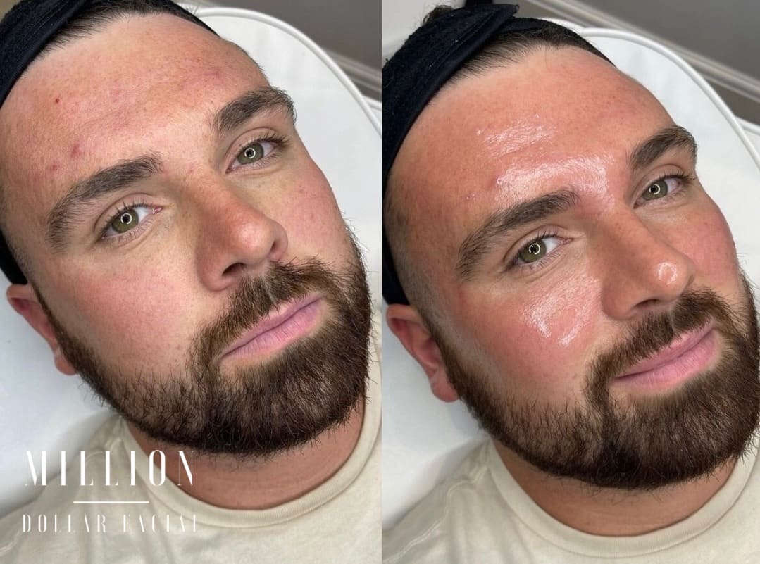 Million Dollar Facial Results