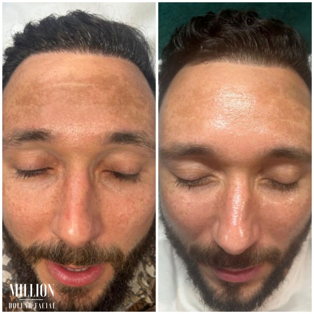 Million Dollar Facial Results