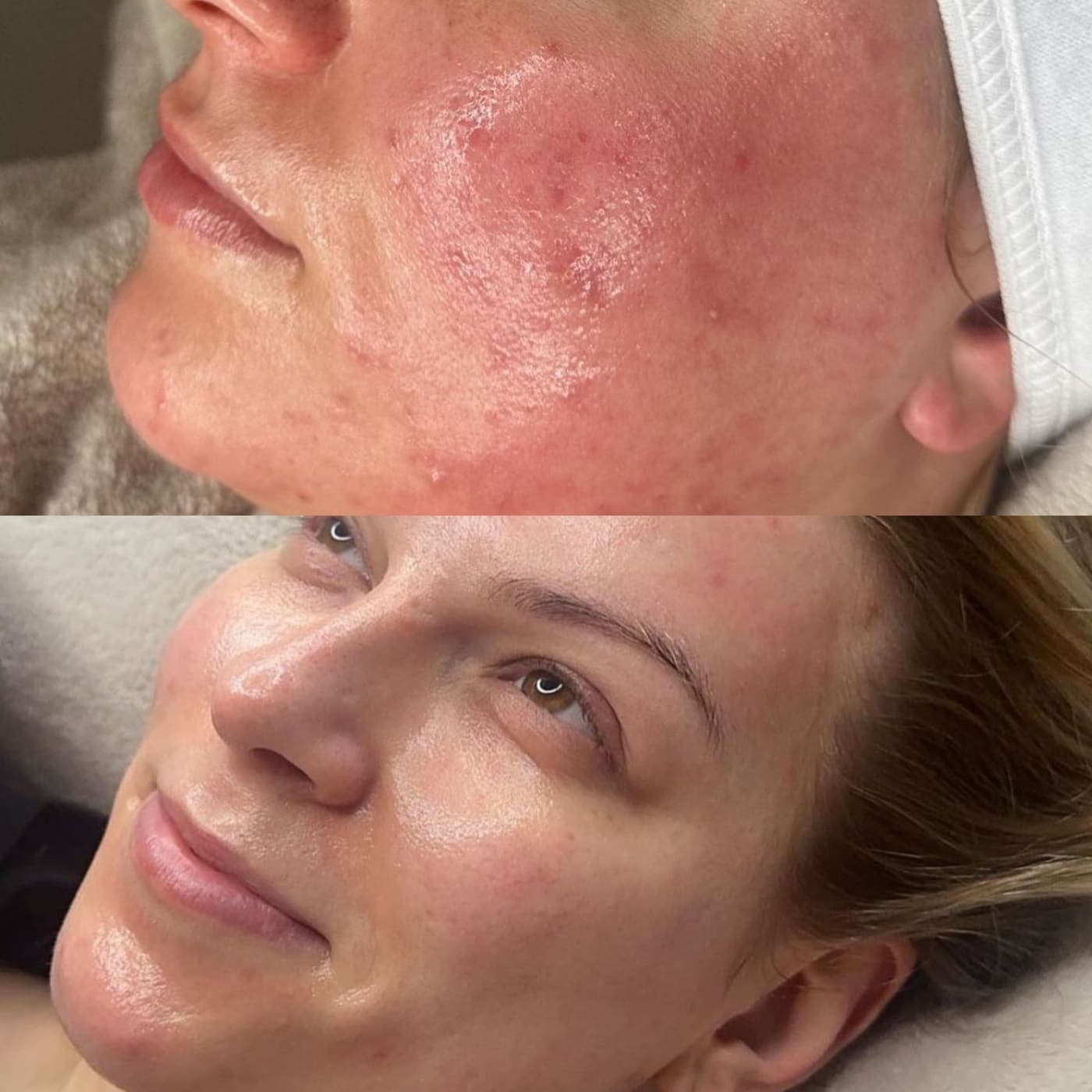 Signature Skin Treatment Results