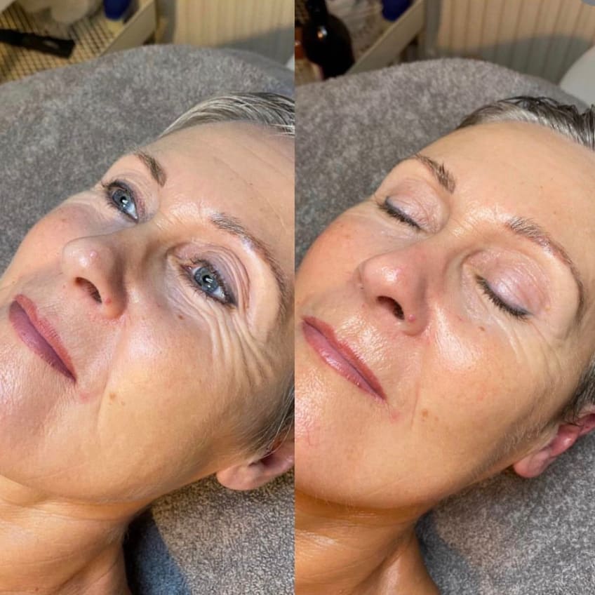 Signature Skin Treatment Results
