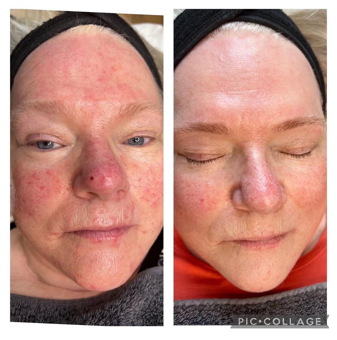 Million Dollar Facial Results