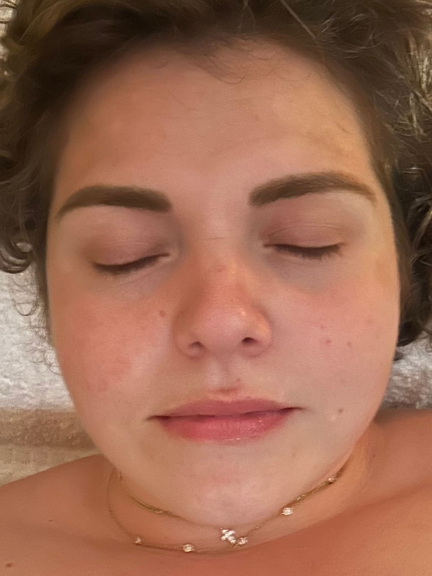 Million Dollar Facial Results