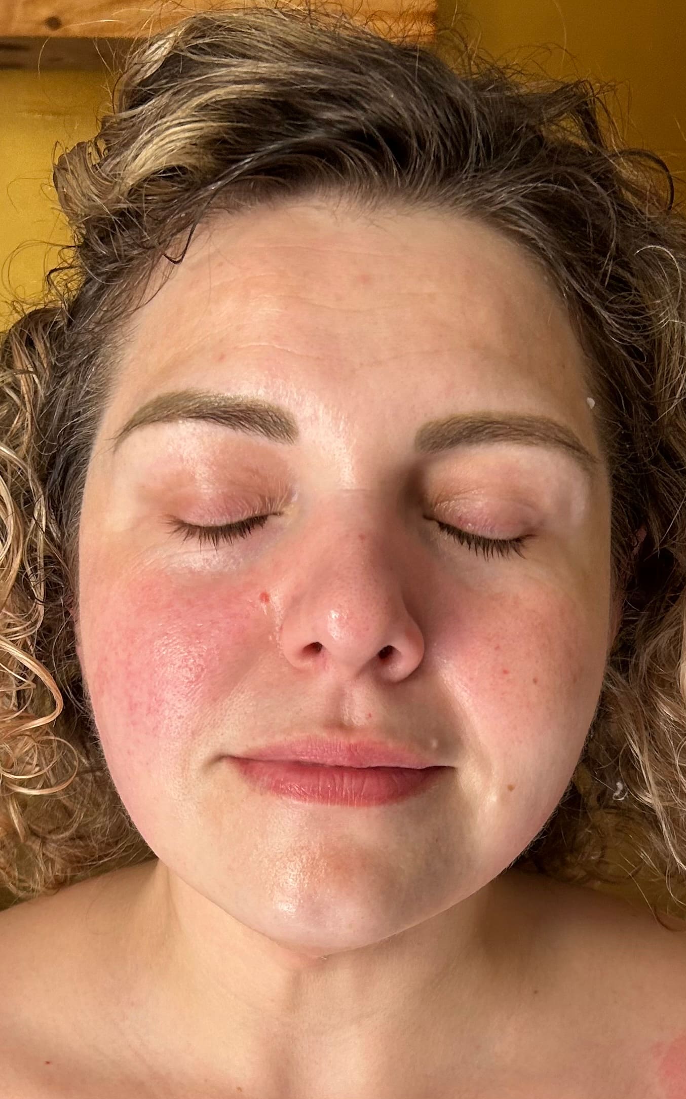 Million Dollar Facial Results